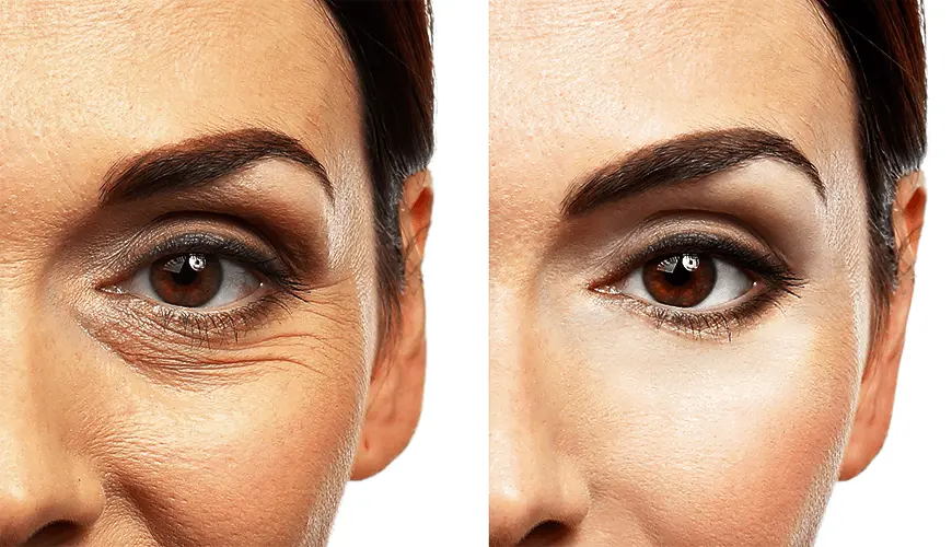 جراحة رأب العين